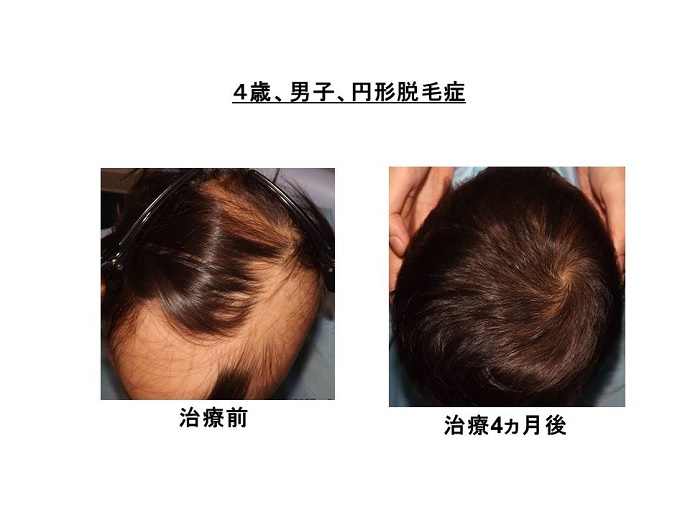 円形脱毛症　病院""
